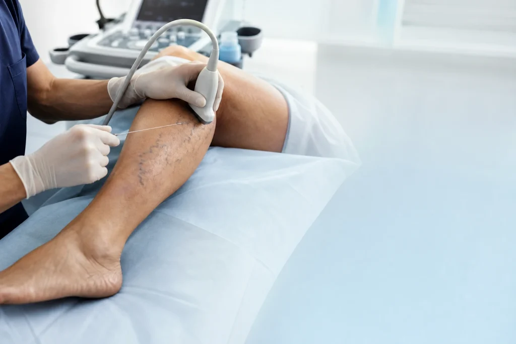 What to Know About Varicose Veins